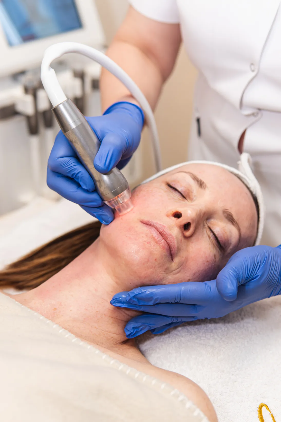 Microneedling mit dem GlowSolution-Handstück bei La Finesse
